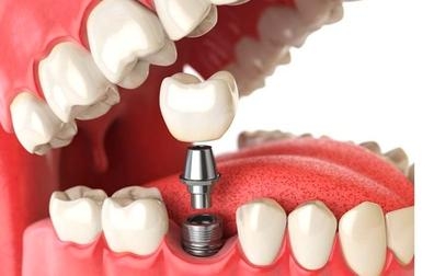 PROTÉSICO DENTAL CERAMISTA CIUDAD REAL