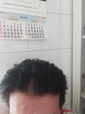 caida de cabello